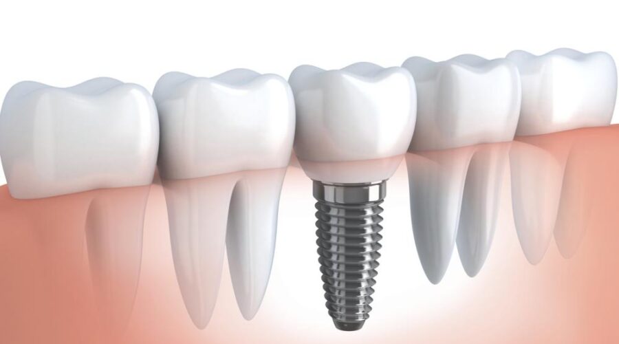 Ile kosztuje implant zęba?
