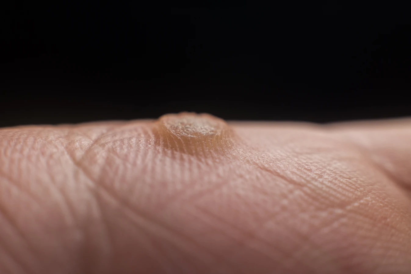 Co jest dobre na kurzajki?