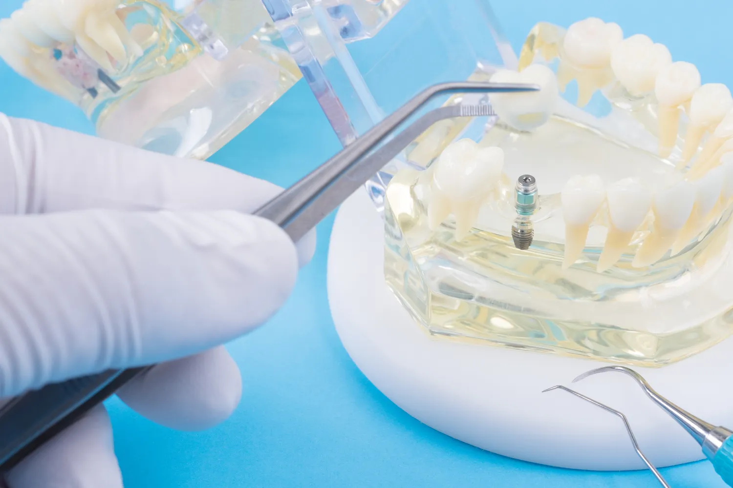 Co to są implanty zębowe?