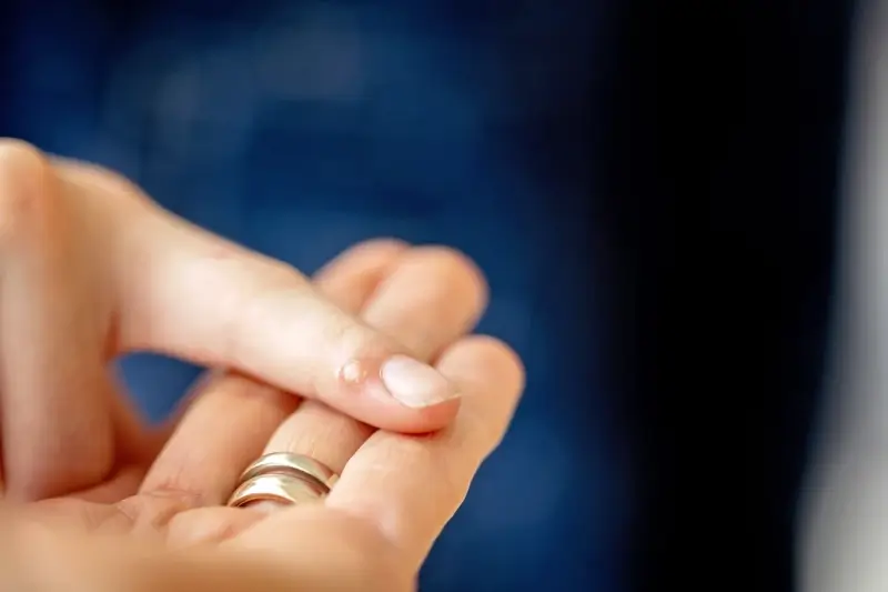 Czy kurzajki w ciąży są groźne?